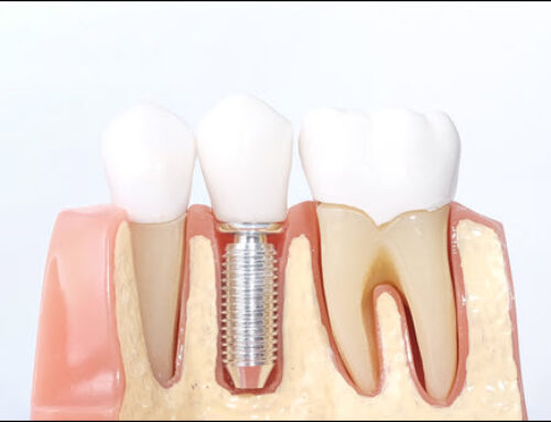 Dental Implants: Fill in the Gaps