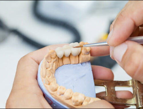 Dental Bridges in Oral Health: Smile with Confidence