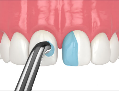 Dental Bonding: A Simple Solution to Restore and Enhance Your Smile