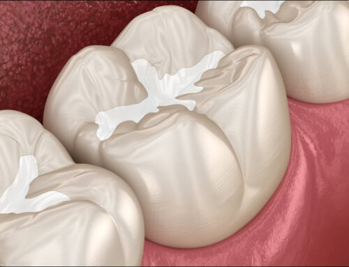 Dental Sealants: Protecting Teeth from Cavities