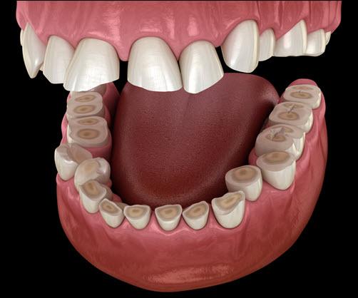 Bruxism