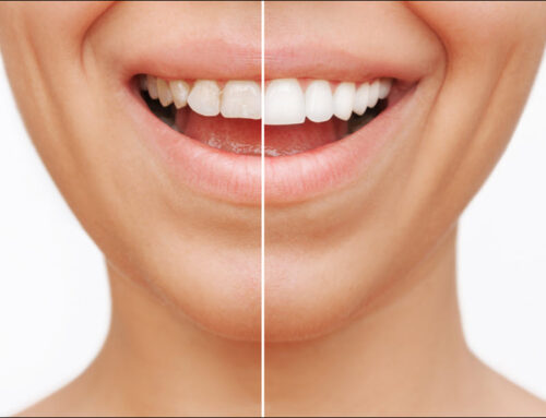 How Dental Veneers Can Transform a Smile Instantly